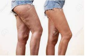 massage#cellulite#drainage lymphatique€ventouses#soins esthétiques